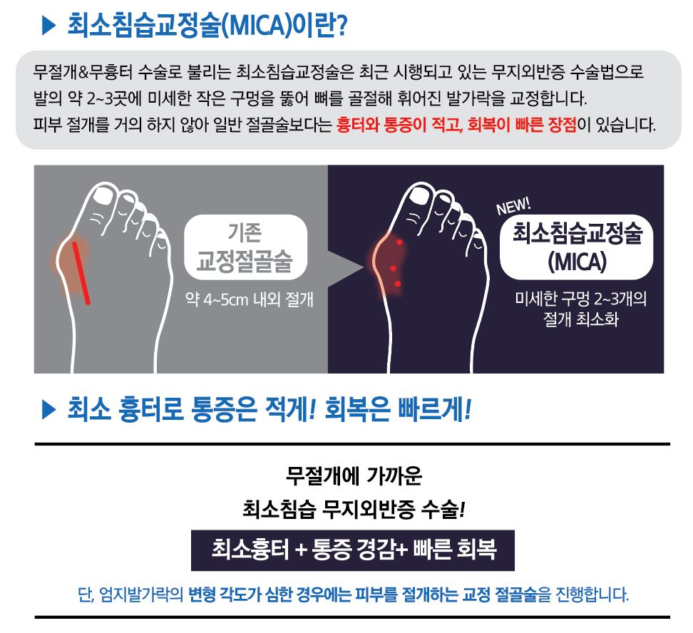 e0f19e42fd43d63a8098524b722f25b5_최소침습무지외반증수술 광명새움병원.JPG