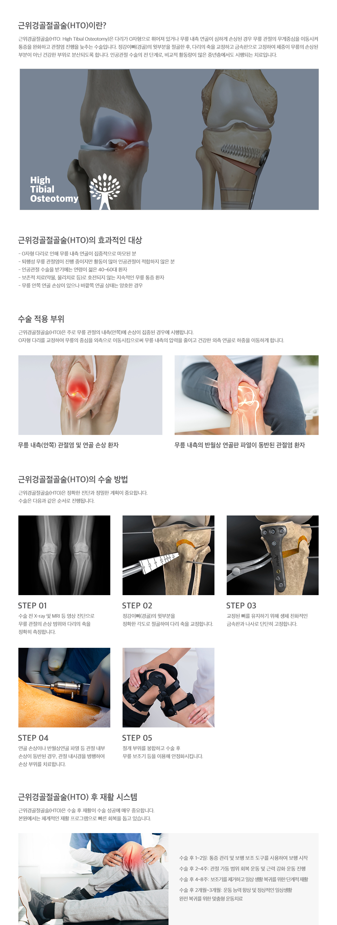 <h3>근위경골절골술이란</h3> <p>다리가 O자형으로 휘어져 있거나 무릎 내측 연골이 심하게 손상된 경우 무릎 관절의 무게중심을 이동시켜 통증을 완화하고 관절염 진행을 늦추는 수술입니다. 정강이뼈(경골)의 윗부분을 절골한 후, 다리의 축을 교정하고 금속판으로 고정하여 체중이 무릎의 손상된 부분이 아닌 건강한 부위로 분산되도록 합니다. 이 수술은 O자형 다리로 인해 무릎 내측 연골이 집중적으로 마모되었거나 무릎 안쪽 연골 손상이 있으나 바깥쪽 연골 상태는 양호한 경우 효과적입니다.</p>